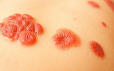 Podzimní alergie vs. parazitní svědění – jak je rozlišit?